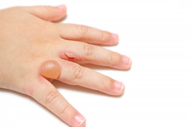 火傷の水ぶくれに対する家庭療法